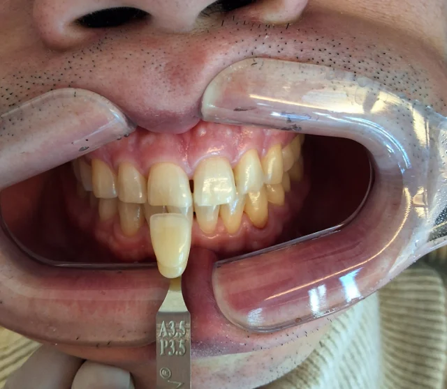 Professional whitening: shade tabs and front teeth at New York S Dental Clinic. New York S Dental Clinic — Professional whitening: shade tabs and front teeth, clinical view 1 of 2.