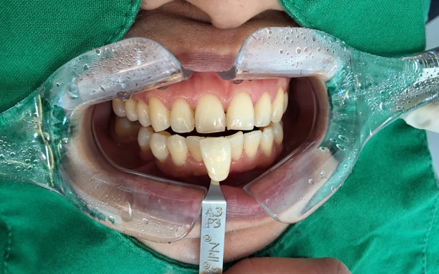 Professional whitening: frontal comparison with shade references at New York S Dental Clinic. New York S Dental Clinic — Professional whitening: frontal comparison with shade references, clinical view 1 of 2.