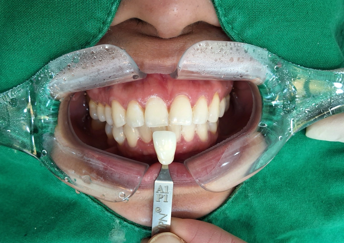Professional whitening: frontal comparison with shade references at New York S Dental Clinic. New York S Dental Clinic — Professional whitening: frontal comparison with shade references, clinical view 2 of 2.