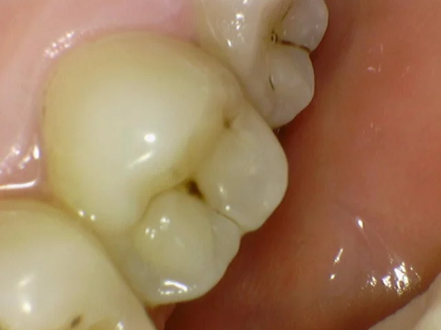 Tooth 17: resin restoration of chewing-surface decay at New York S Dental Clinic. New York S Dental Clinic — Tooth 17: resin restoration of chewing-surface decay, clinical view 1 of 2.