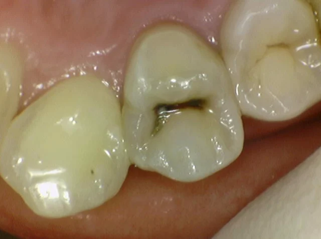 Tooth 15: resin restoration of chewing-surface decay at New York S Dental Clinic. New York S Dental Clinic — Tooth 15: resin restoration of chewing-surface decay, clinical view 1 of 2.