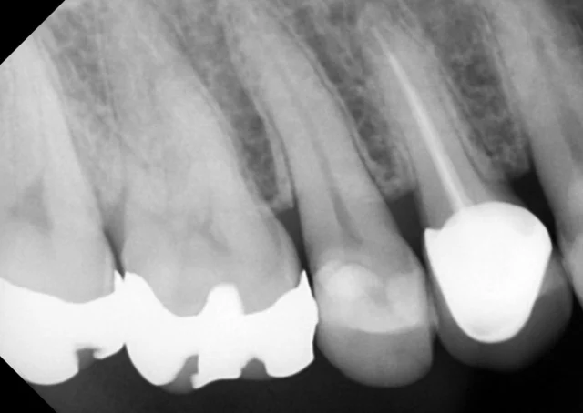 Tooth 15: root canal treatment X-rays at New York S Dental Clinic. New York S Dental Clinic — Tooth 15: root canal treatment X-rays, clinical view 1 of 2.