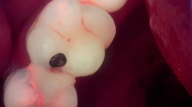 Tooth 26: resin restoration of mesial and chewing surfaces at New York S Dental Clinic. New York S Dental Clinic — Tooth 26: resin restoration of mesial and chewing surfaces, clinical view 1 of 2.