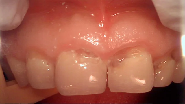 Front teeth 11 and 21: anterior resin restoration at New York S Dental Clinic. New York S Dental Clinic — Front teeth 11 and 21: anterior resin restoration, clinical view 1 of 2.