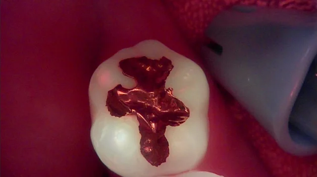 Tooth 47: resin repair after a dislodged inlay at New York S Dental Clinic. New York S Dental Clinic — Tooth 47: resin repair after a dislodged inlay, clinical view 1 of 3.