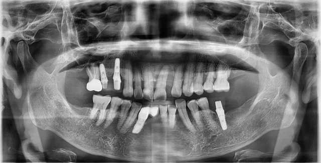 Upper front teeth: four-unit PFZ bridge at New York S Dental Clinic. New York S Dental Clinic — Upper front teeth: four-unit PFZ bridge, clinical view 1 of 6.