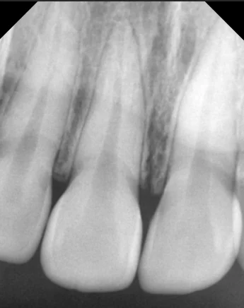 Gingivectomy for gum overgrowth between front teeth at New York S Dental Clinic. New York S Dental Clinic — Gingivectomy for gum overgrowth between front teeth, clinical view 1 of 3.
