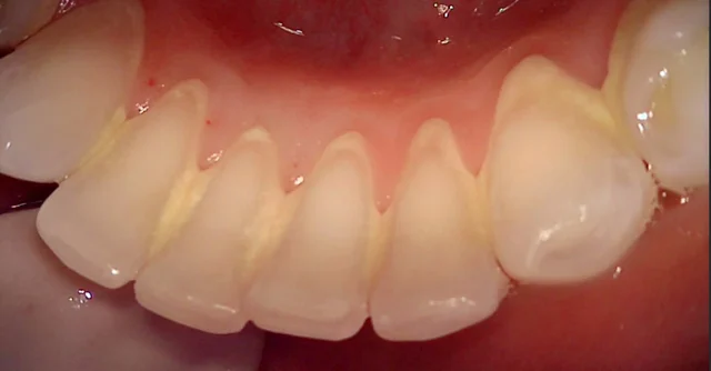 Scaling and root planing: multiple gumline views at New York S Dental Clinic. New York S Dental Clinic — Scaling and root planing: multiple gumline views, clinical view 1 of 7.