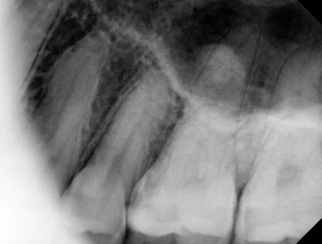 Tooth 26: recurrent decay restored with A2 resin at New York S Dental Clinic. New York S Dental Clinic — Tooth 26: recurrent decay restored with A2 resin, clinical view 1 of 3.