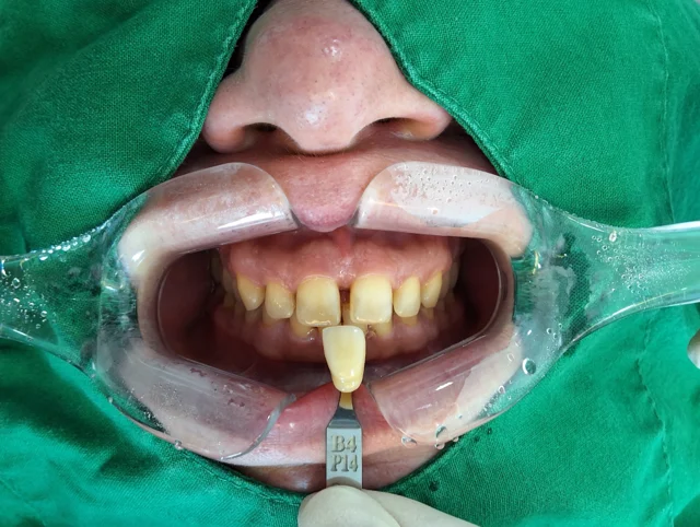 Professional whitening: retracted smile comparison at New York S Dental Clinic. New York S Dental Clinic — Professional whitening: retracted smile comparison, clinical view 1 of 2.