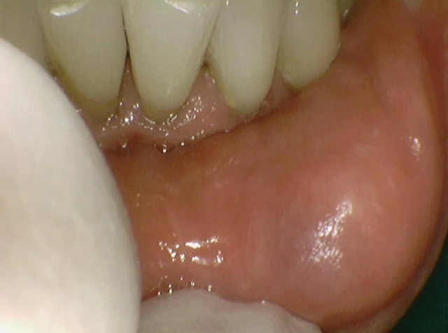 Lower-lip mucocele removal: excisional biopsy sequence at New York S Dental Clinic. New York S Dental Clinic — Lower-lip mucocele removal: excisional biopsy sequence, clinical view 1 of 4.