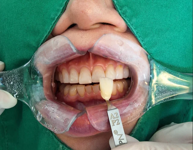Professional whitening: close-up comparison with shade tabs at New York S Dental Clinic. New York S Dental Clinic — Professional whitening: close-up comparison with shade tabs, clinical view 1 of 2.