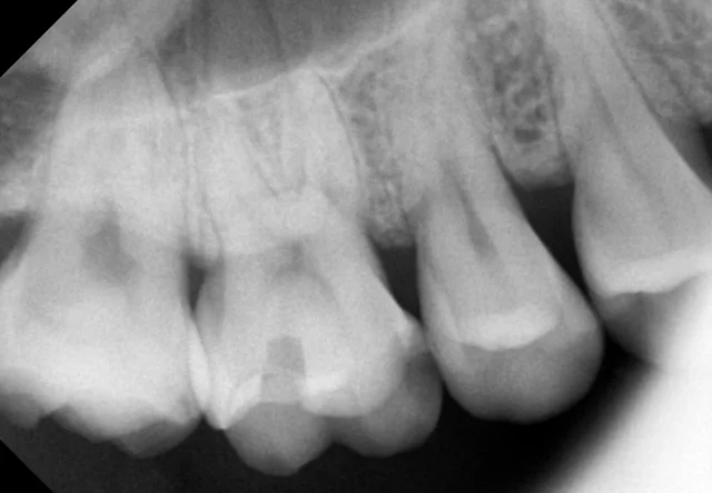 Tooth 16: resin restoration after a fractured hybrid inlay at New York S Dental Clinic. New York S Dental Clinic — Tooth 16: resin restoration after a fractured hybrid inlay, clinical view 1 of 4.