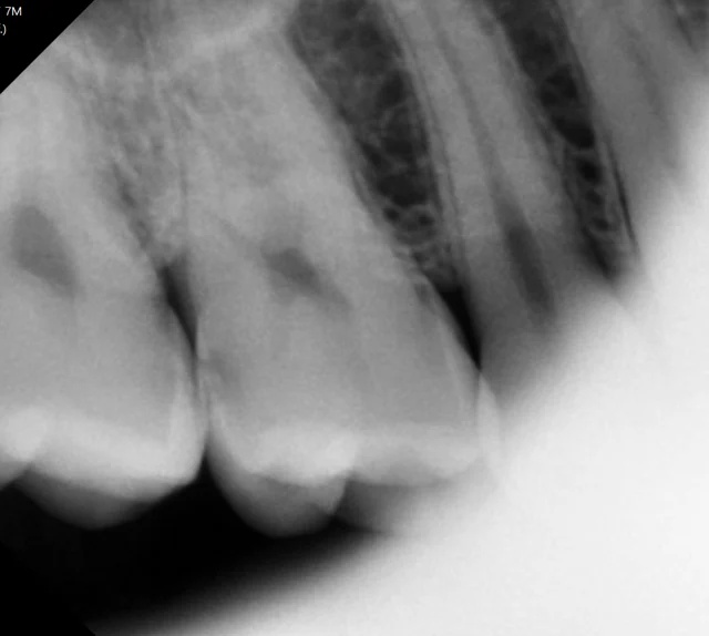 Tooth 16: distal and chewing-surface resin restoration at New York S Dental Clinic. New York S Dental Clinic — Tooth 16: distal and chewing-surface resin restoration, clinical view 1 of 2.