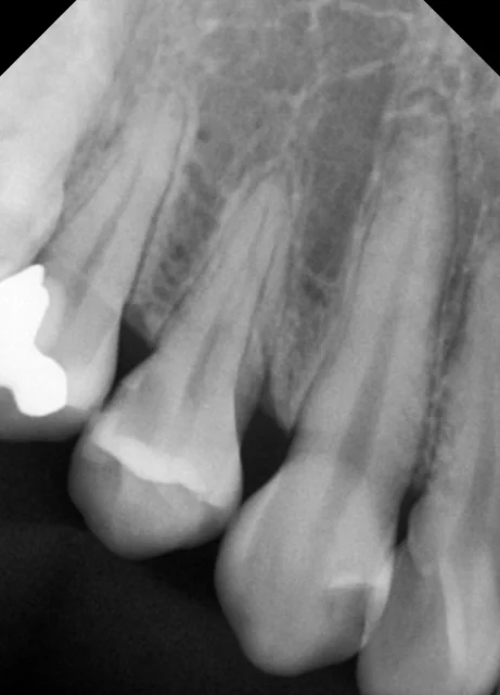 Tooth 14: resin restoration for decay between teeth at New York S Dental Clinic. New York S Dental Clinic — Tooth 14: resin restoration for decay between teeth, clinical view 1 of 3.