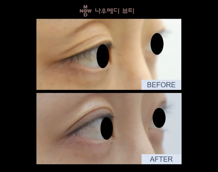Eyelid surgery: an oblique close-up at NOWMEDI Clinic. Before above; after below. Follow-up timing is not supplied.