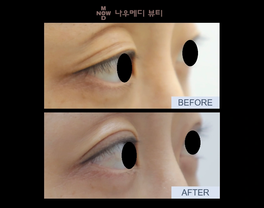 Eyelid surgery: an oblique close-up at NOWMEDI Clinic. Before above; after below. Follow-up timing is not supplied.