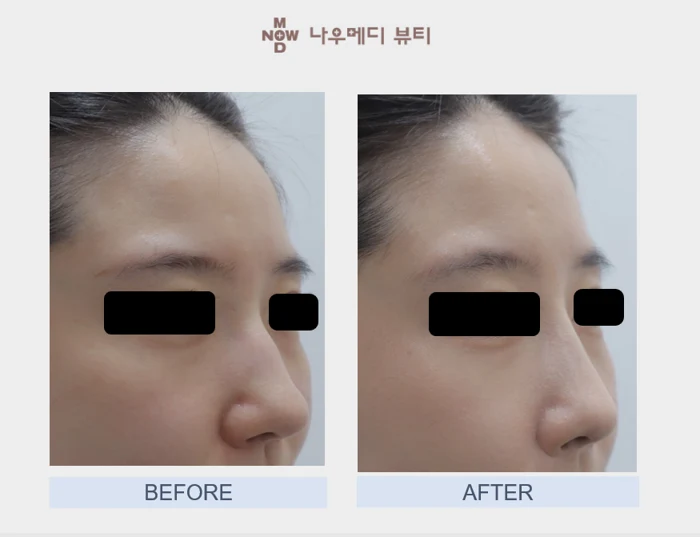 Mijuko: bridge and tip comparison at NOWMEDI Clinic. Before on the left; after on the right. Follow-up timing is not supplied.