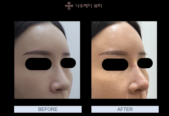 Mijuko: angled nose comparison at NOWMEDI Clinic. Before on the left; after on the right. Follow-up timing is not supplied.