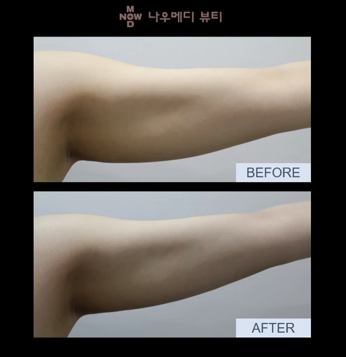 ONDA: upper-arm comparison at NOWMEDI Clinic. Before above; after below. Follow-up timing is not supplied.