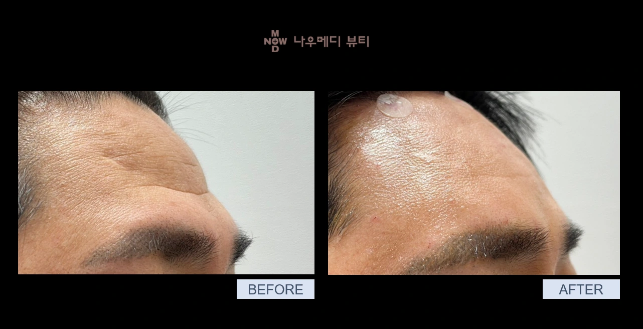 Radiesse: forehead comparison at NOWMEDI Clinic. Before on the left; after on the right. Follow-up timing is not supplied.