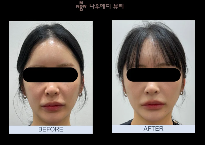 Ultherapy: front-view facial comparison at NOWMEDI Clinic. Before on the left; after on the right. Follow-up timing is not supplied.