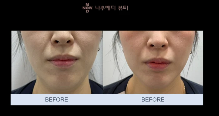 Ultherapy: lower-face photographs at NOWMEDI Clinic. Left and right lower-face photographs. Both source labels read Before; image order is unconfirmed.