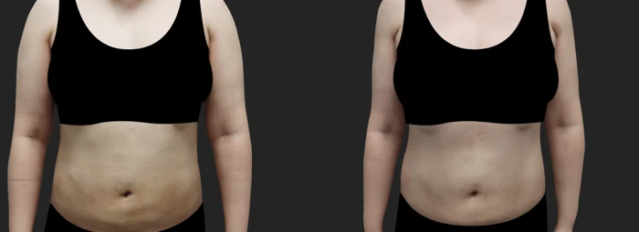 Arm and upper-back liposuction — one month before and after at OWN Clinic Samseong
