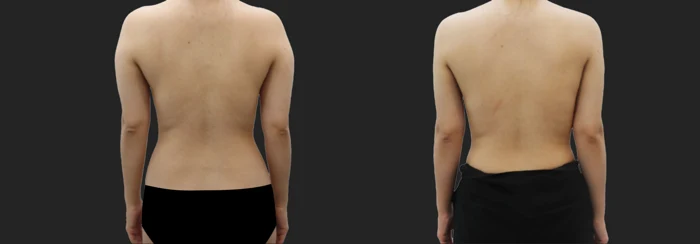 Arm and underarm liposuction — one month before and after at OWN Clinic Samseong