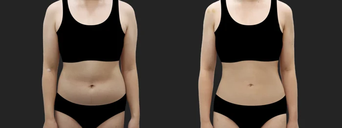 Arm and abdominal liposuction — one month before and after at OWN Clinic Samseong
