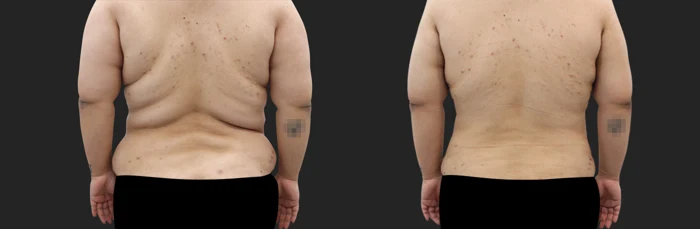 Arm and abdominal liposuction — three months before and after at OWN Clinic Samseong
