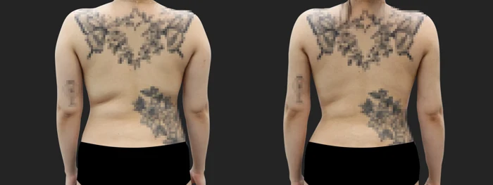 Arm, back and flank liposuction — six weeks before and after at OWN Clinic Samseong