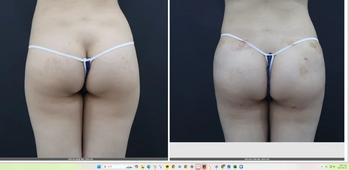 Buttock contour comparison before and after at OWN Clinic Samseong