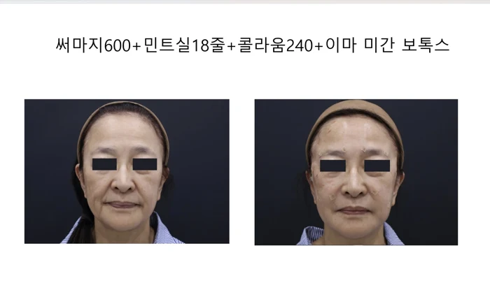 Combined facial lifting treatment before and after at OWN Clinic Samseong