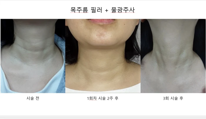 Neck-line filler and skin booster before and after at OWN Clinic Samseong