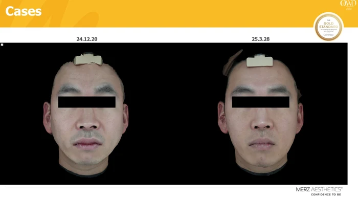 Ultherapy facial comparison before and after at OWN Clinic Samseong