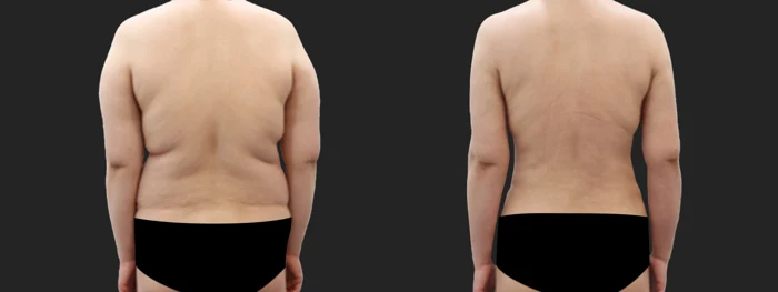 Upper-body liposuction — two months before and after at OWN Clinic Samseong
