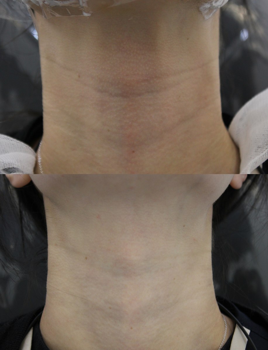 Neck line comparison at PLANEW Clinic. Neck line comparison at PLANEW Clinic: Stacked close-ups show the front of the neck and its horizontal lines. The framing and neck position differ between the two photographs.