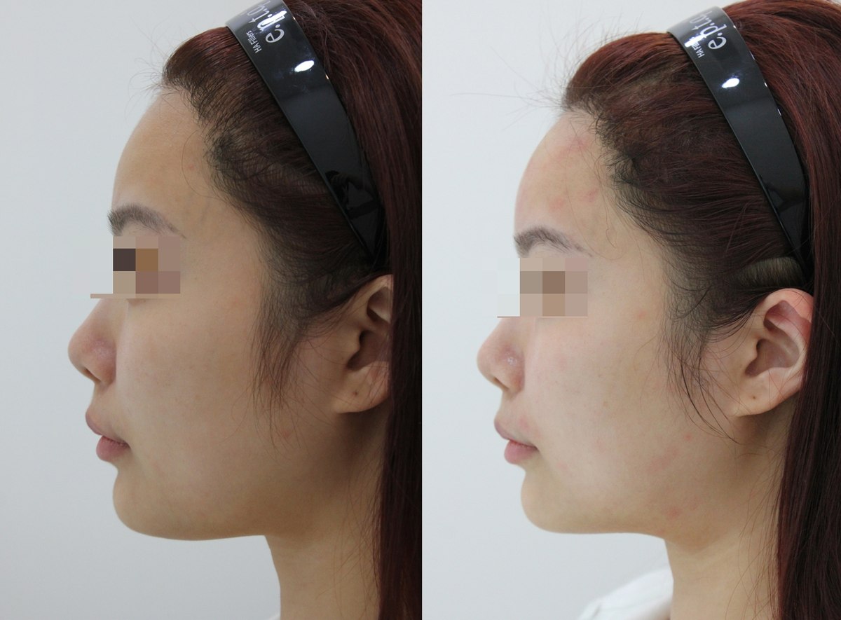 Onda lifting — left profile at PLANEW Clinic. Onda lifting — left profile at PLANEW Clinic: Side-by-side views facing left show the lower cheek, jawline and the area beneath the chin. Head position and lighting vary between photographs.