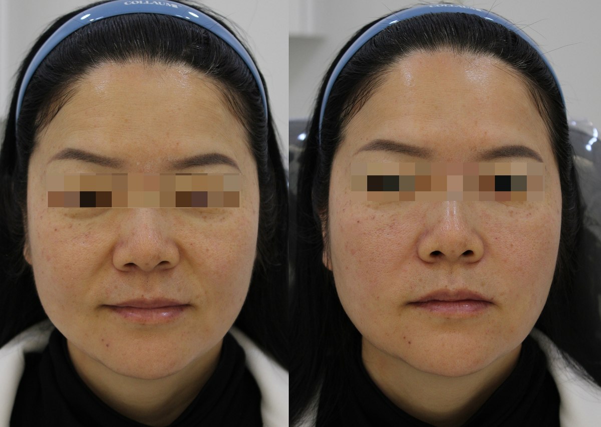 Nasolabial fold filler — frontal view at PLANEW Clinic. Nasolabial fold filler — frontal view at PLANEW Clinic: Two frontal views show the folds beside the nose and the area around the mouth. Compare the photographs with attention to facial expression and lighting.