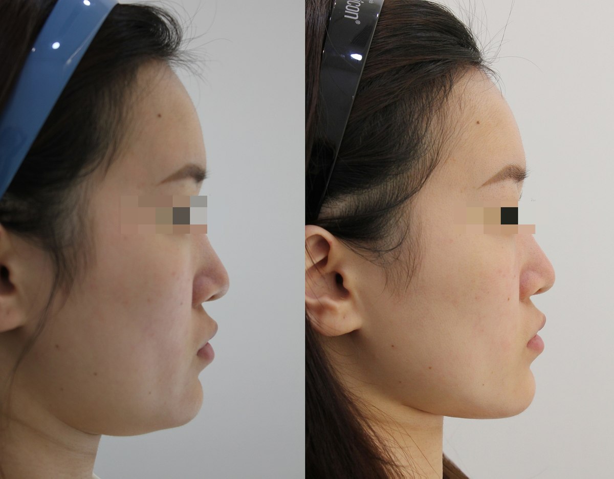 Onda lifting — right profile at PLANEW Clinic. Onda lifting — right profile at PLANEW Clinic: Two views facing right show the cheek, lower-face outline and chin-to-neck transition. The camera angle and head position are not identical.