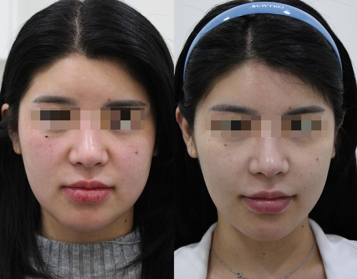 Onda and Titanium lifting — frontal view at PLANEW Clinic. Onda and Titanium lifting — frontal view at PLANEW Clinic: Frontal photographs show the cheeks and lower-face outline after the combination named in the supplied file. The comparison cannot separate the contribution of Onda from Titanium.
