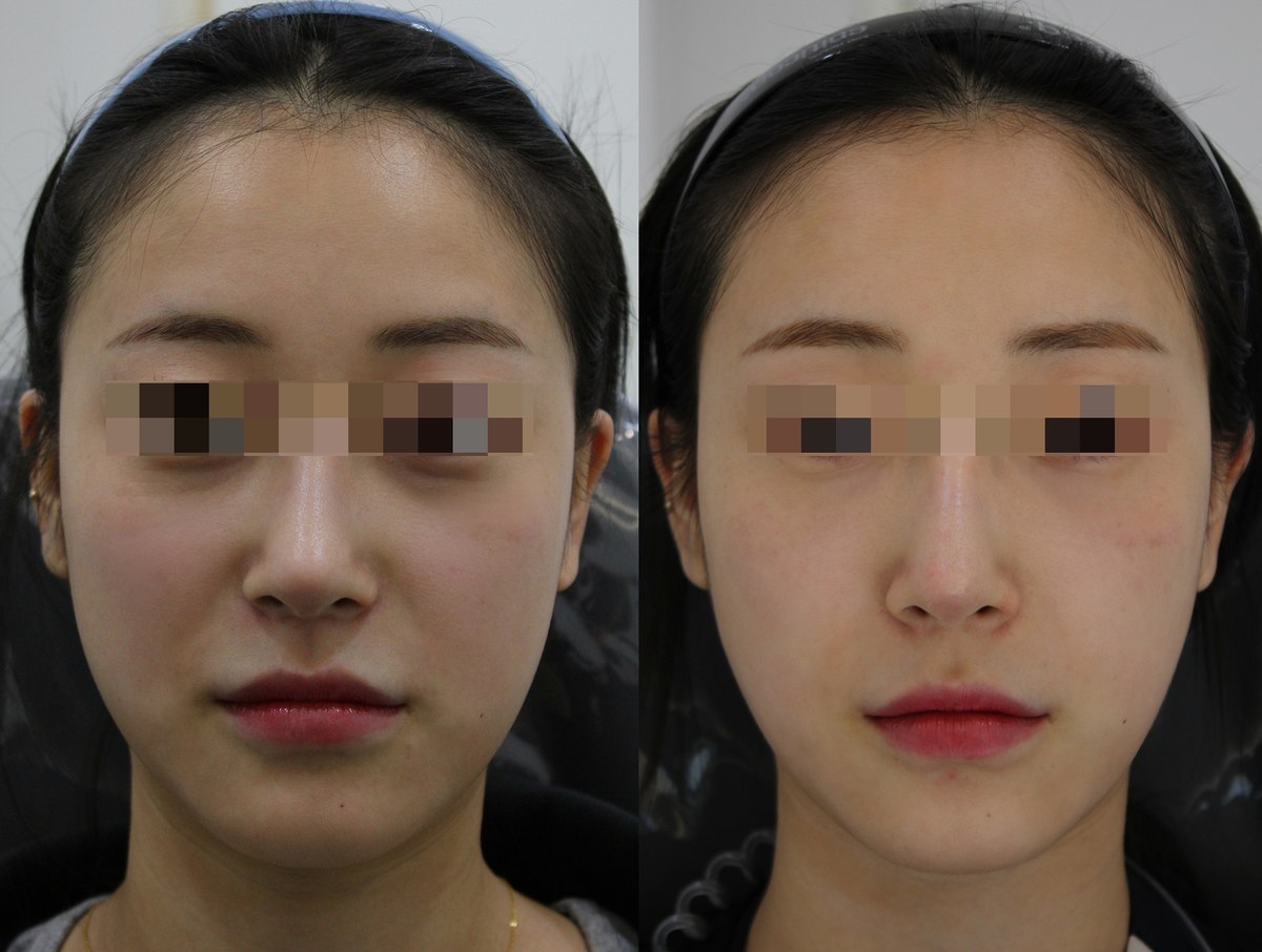 Collagen injections — under-eye and nasolabial areas at PLANEW Clinic. Collagen injections — under-eye and nasolabial areas at PLANEW Clinic: Frontal views show the cheeks and folds beside the nose. The supplied label names the under-eye and nasolabial areas; eye coverings obscure part of the treated region.