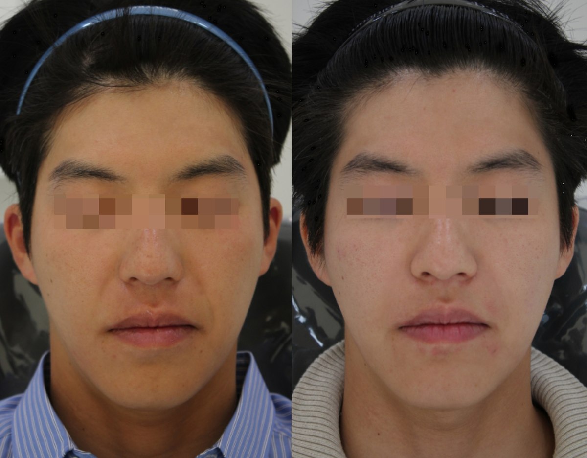 Facial comparison — frontal view 01 at PLANEW Clinic. Facial comparison — frontal view 01 at PLANEW Clinic: Frontal views show the cheeks, mouth and lower-face outline. Hair position, skin shine and lighting differ between the two photographs.
