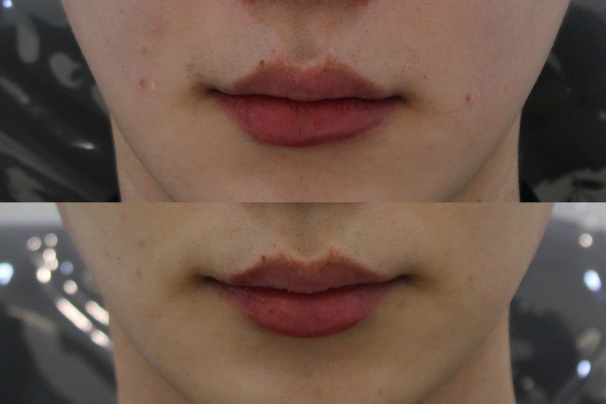 Lip comparison — close-up 01 at PLANEW Clinic. Lip comparison — close-up 01 at PLANEW Clinic: Stacked close-ups show the upper and lower lips, Cupid’s bow and mouth corners. The lower photograph has a closer crop; no product or treatment name was supplied.