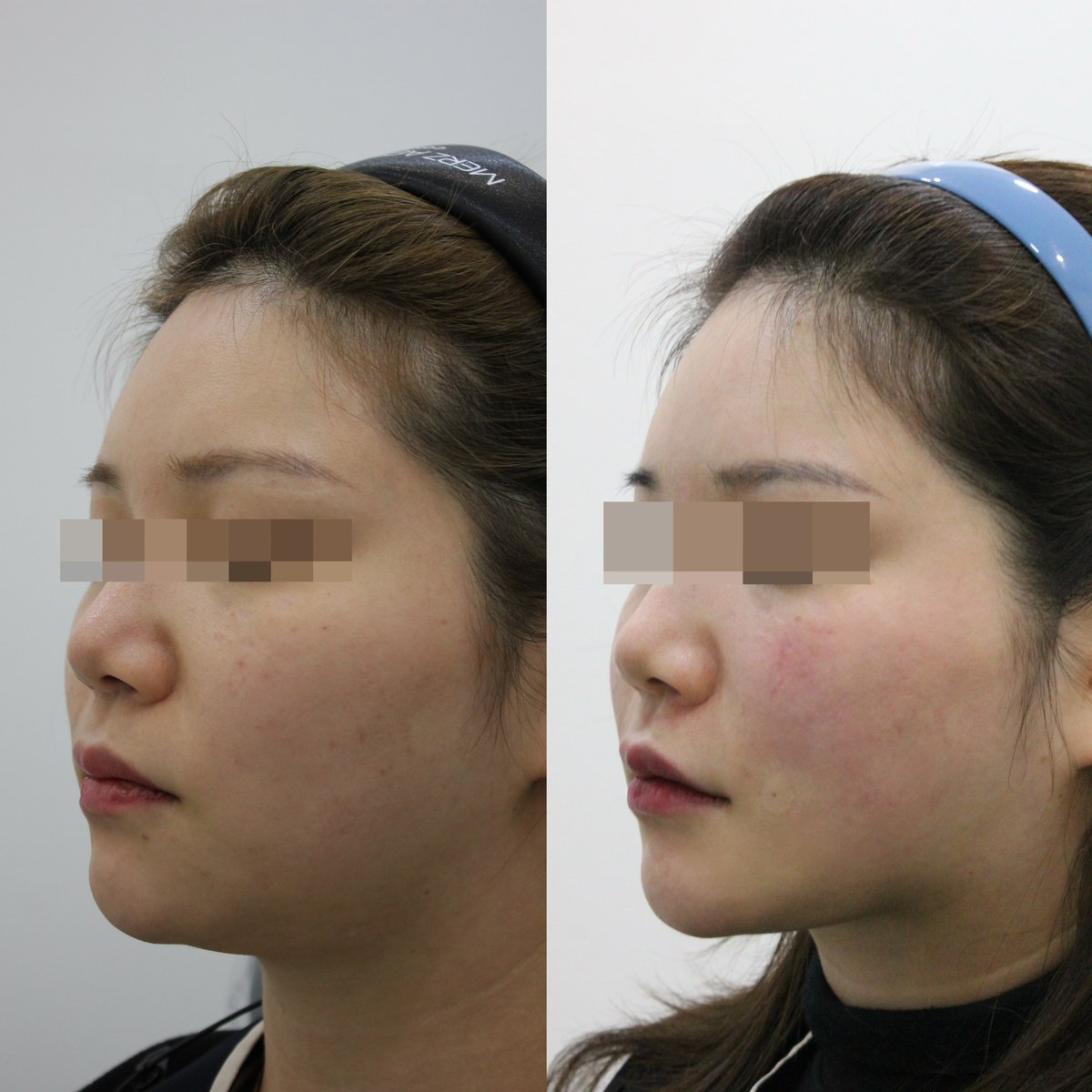 Facial comparison — left oblique view at PLANEW Clinic. Facial comparison — left oblique view at PLANEW Clinic: Two oblique views facing left show the forehead, cheek and jawline. Small differences in head rotation affect the visible outline.
