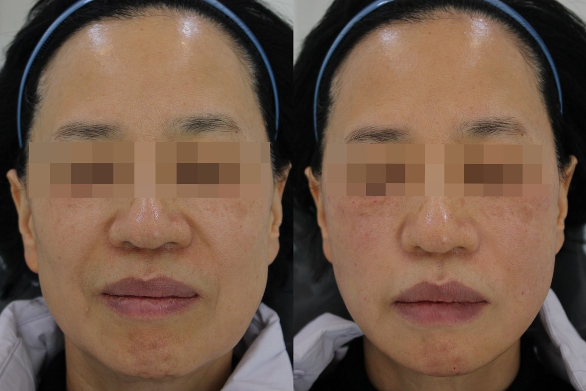 Facial comparison — frontal view 02 at PLANEW Clinic. Facial comparison — frontal view 02 at PLANEW Clinic: Frontal views show the cheeks and folds around the nose and mouth. Skin reflectivity differs between the photographs and should be considered when comparing them.