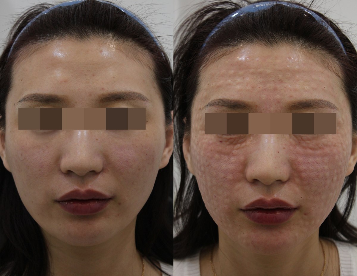 Skin comparison — frontal views at PLANEW Clinic. Skin comparison — frontal views at PLANEW Clinic: Two frontal photographs show the forehead and cheeks. Small raised areas and redness are visible in the right-hand image; the files do not identify the treatment or when that photograph was taken.