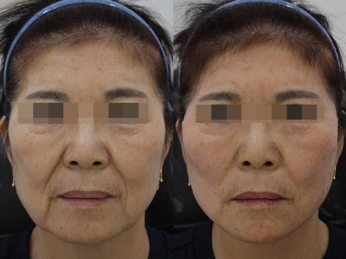 Facial comparison — frontal view 03 at PLANEW Clinic. Facial comparison — frontal view 03 at PLANEW Clinic: Two frontal views show lines around the mouth, the cheeks and lower-face outline. The photographs have different lighting and expressions.