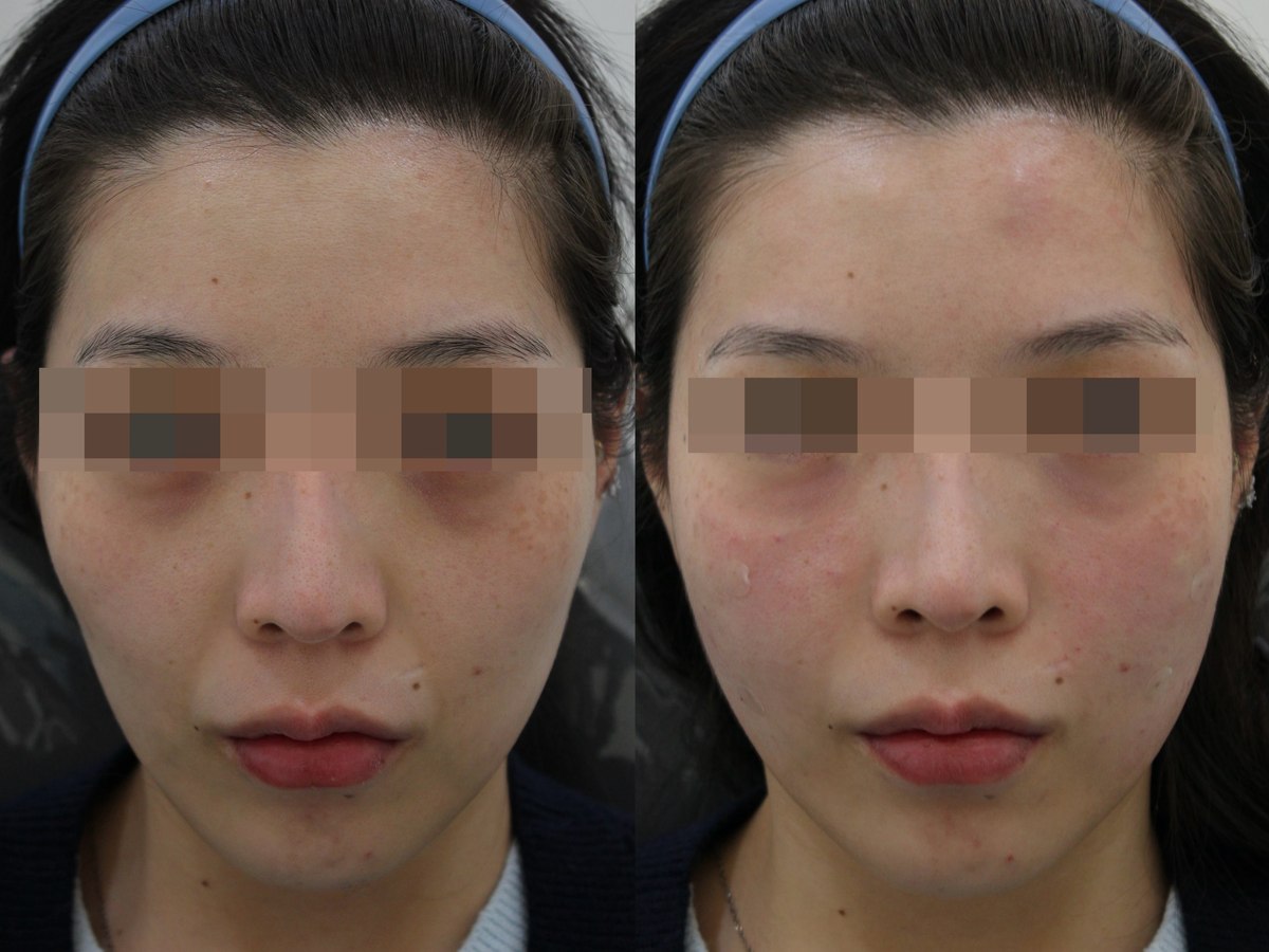 Facial comparison — frontal view 04 at PLANEW Clinic. Facial comparison — frontal view 04 at PLANEW Clinic: Frontal photographs show the forehead, cheeks and the area around the mouth. The eyes are pixelated in the supplied board, limiting comparison of the eye area.